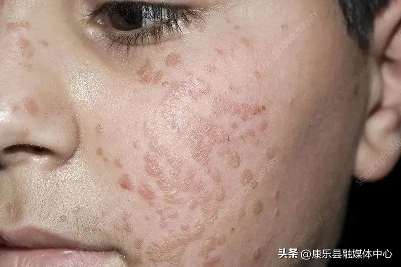 身上長(zhǎng)了HPV，我們?cè)撊绾蚊鎸?duì)與處理